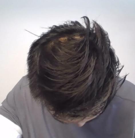 man after hair loss treatment with fuller hair and reduced scalp visibility