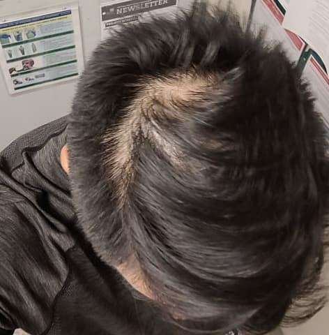 man before hair loss treatment with visible thinning and scalp showing