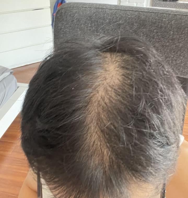 man after hair loss treatment with thinning hair