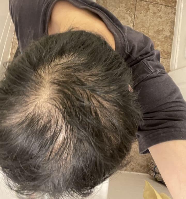 man before hair loss treatment with thinning hairline
