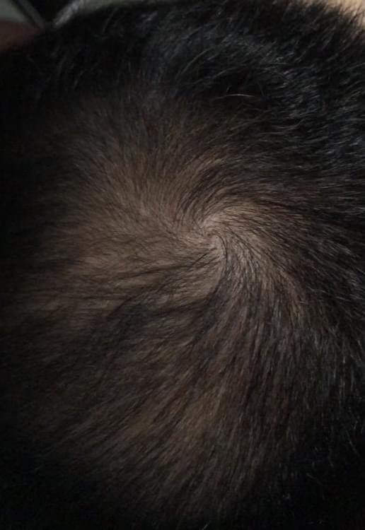 man after hair loss treatment with thinning hair