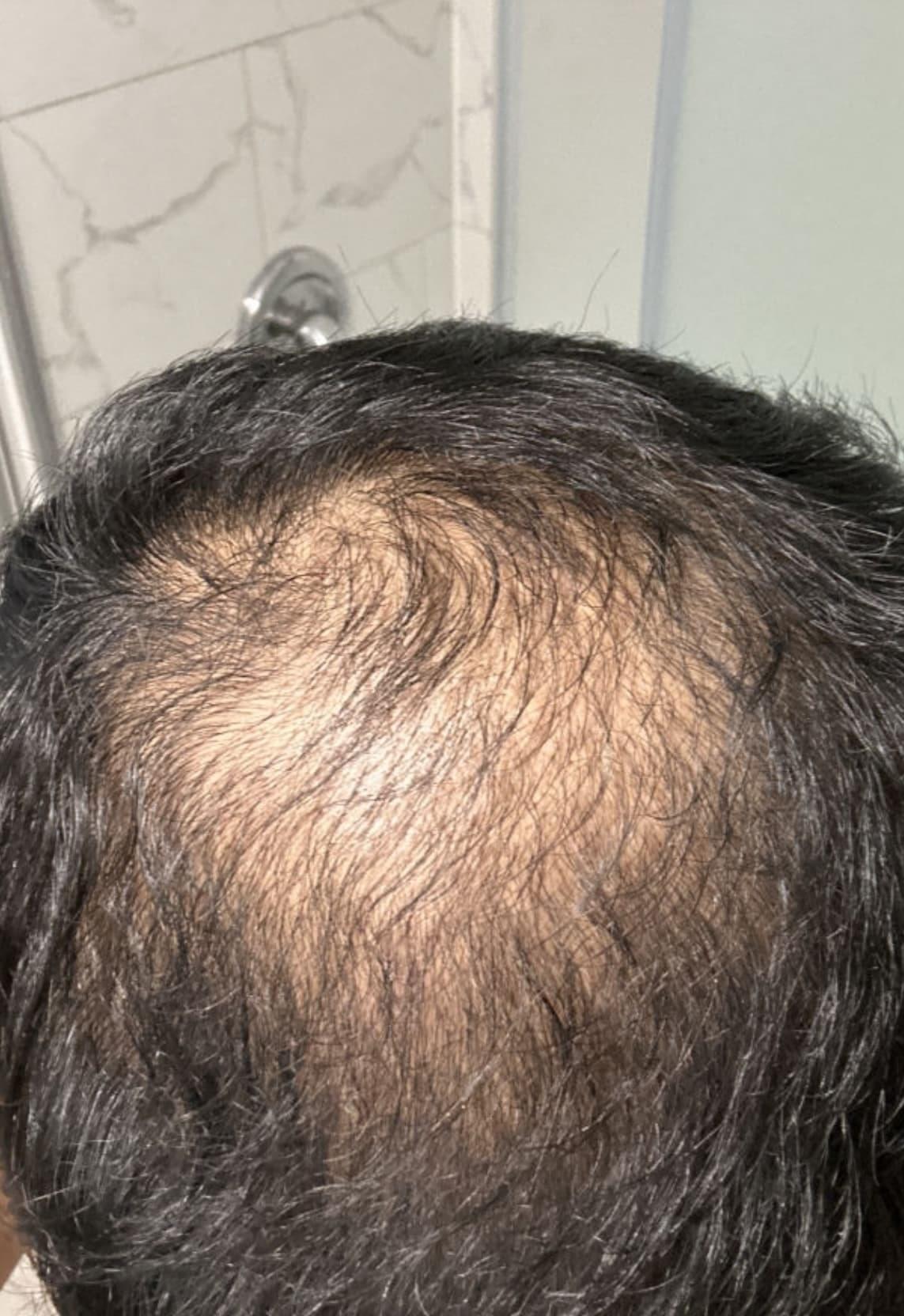 man before hair loss treatment with thinning hairline